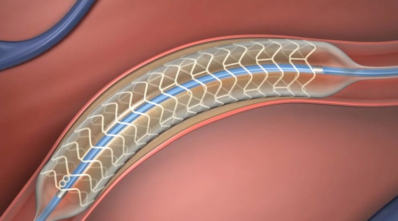 Bioabsorbable Stents: Play an Essential Role in Enlarging the Vessels